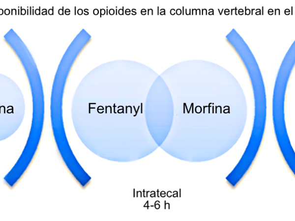 Morfina neuroaxial espinal&nbsp;(subaracnoidea)