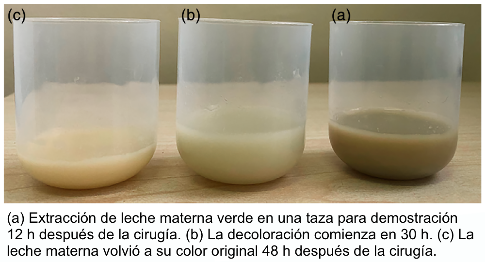 Coloración verdosa de la leche materna por propofol