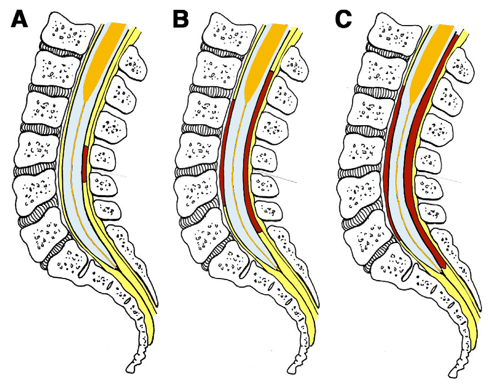 Evolución del parche hemático epidural